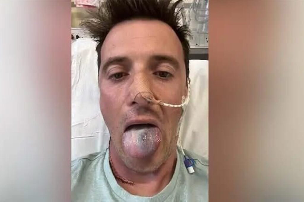 homem-desenvolve-cancer-por-causa-de-hpv-e-quase-perde-a-lingua