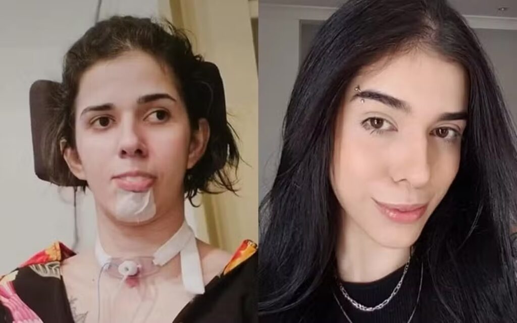 caso-de-jovem-que-teve-sequelas-ao-cheirar-pimenta-completa-3-anos.-veja-o-video