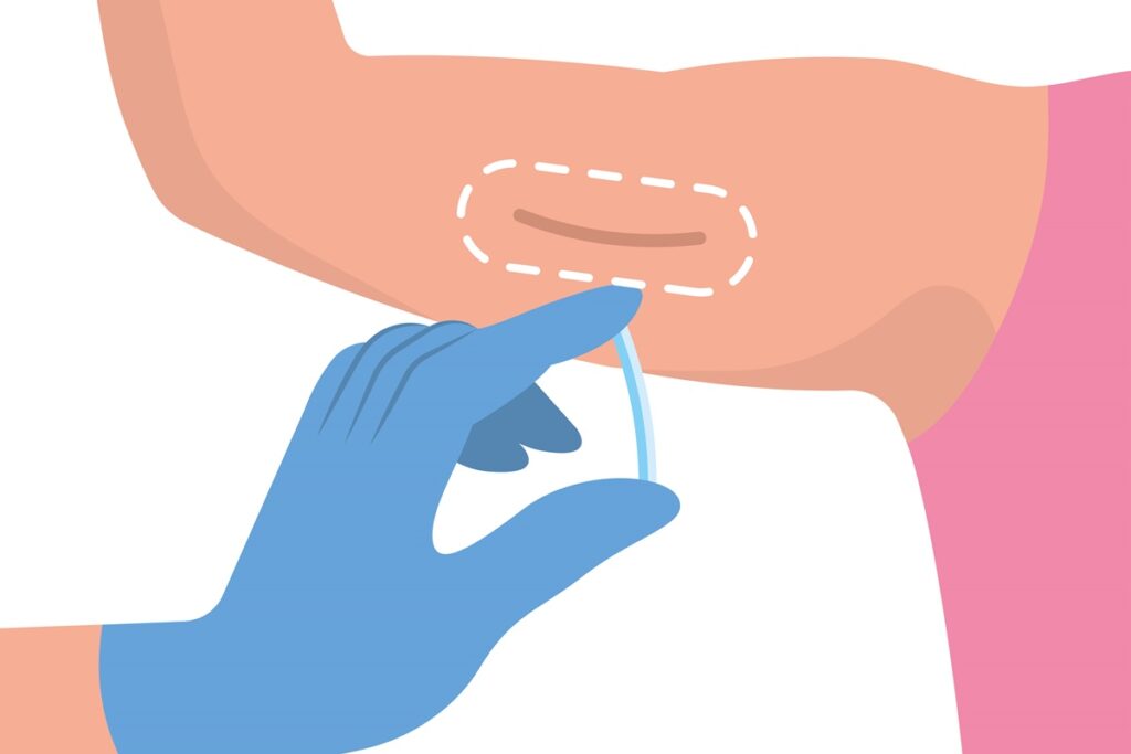 implanon:-saiba-quem-tem-direito-ao-contraceptivo-pela-rede-publica-do-df