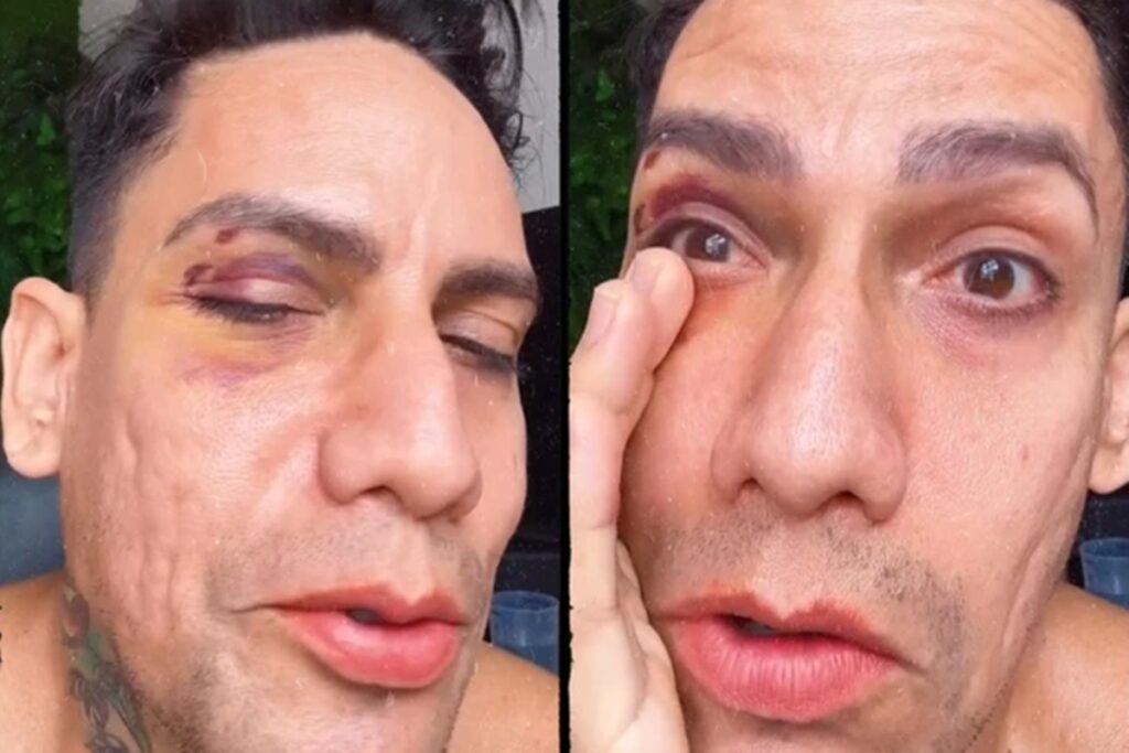 jovem-e-agredido-no-carnaval-de-olinda-apos-se-vestir-como-drag-queen