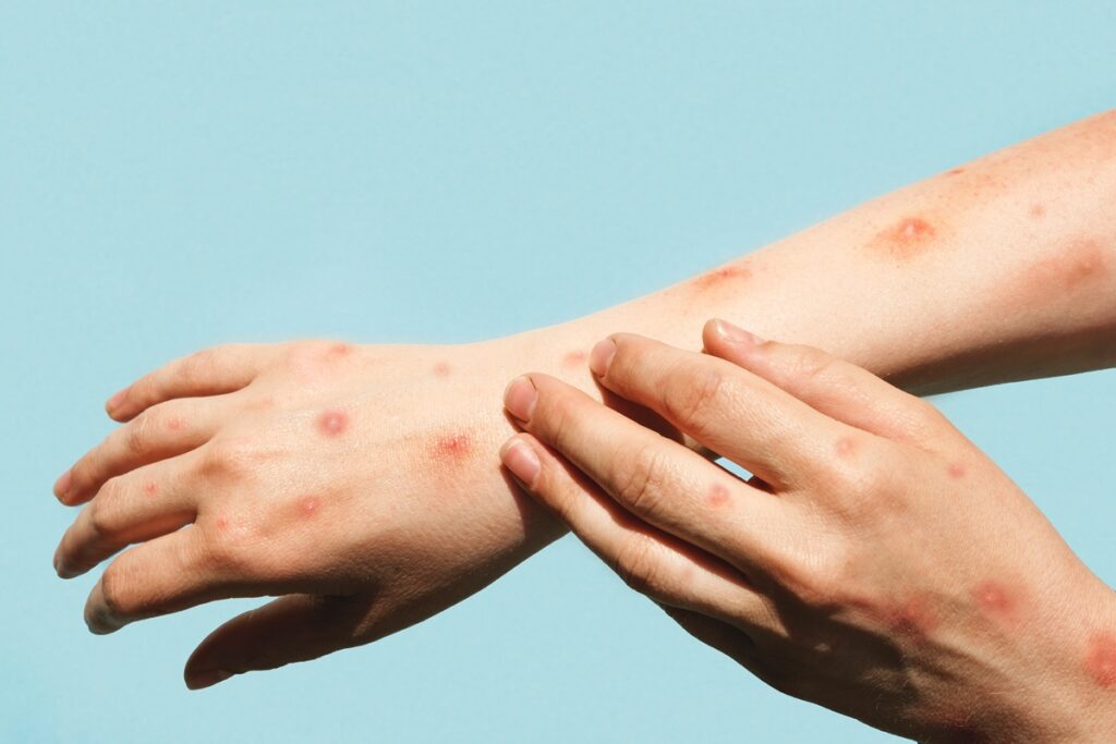 mpox-no-df:-veja-sintomas,-tratamento-e-prevencao-contra-a-doenca