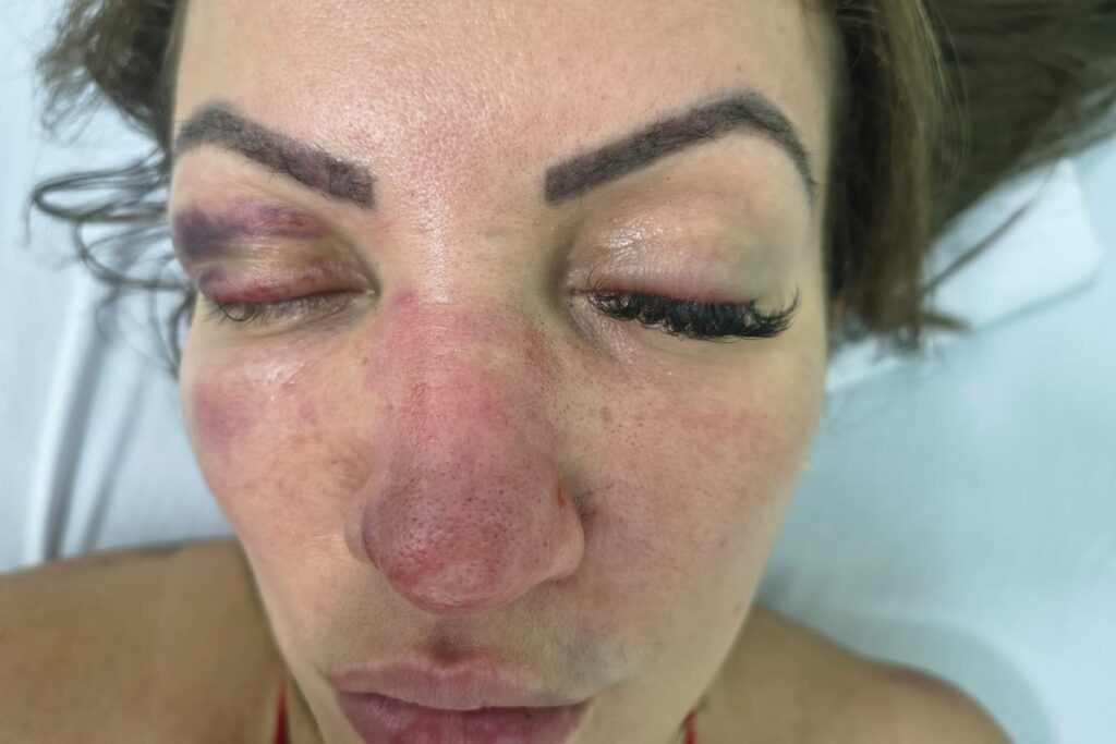 imagens-fortes:-vereadora-em-sp-atropela-namorado-apos-ser-espancada-por-ele.-video