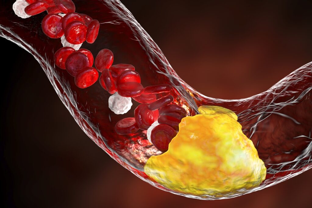 medico-vascular-diz-se-dor-nas-pernas-pode-indicar-arterias-entupidas
