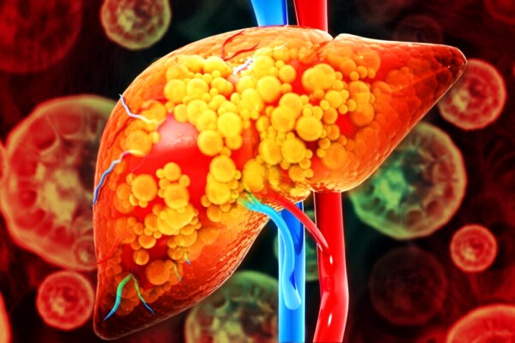 hepatologista-responde:-toda-gordura-no-figado-evolui-para-cirrose?