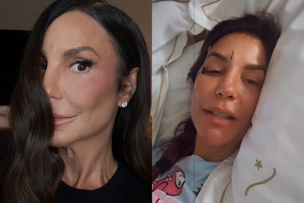 ivete-sangalo-mostra-hematoma-no-rosto-apos-acidente