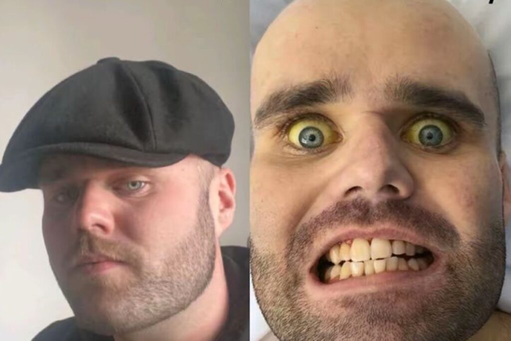 vicio-em-beber-vodca-no-cafe-da-manha-deixa-homem-com-pele-amarelada