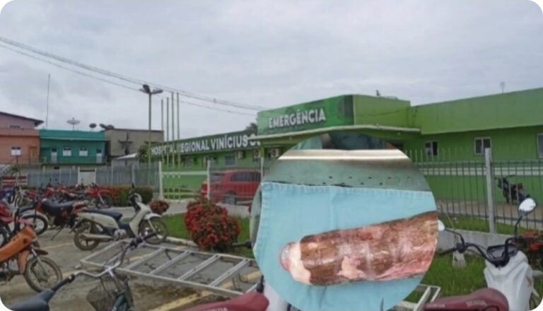 Homem busca atendimento médico em Eirunepé após introdução acidental de vegetal no reto