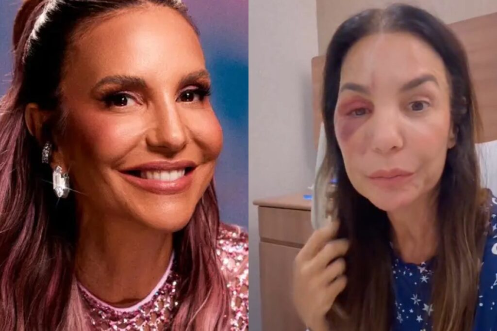 ivete-sangalo-mostra-rosto-com-hematoma-e-esclarece-estado-de-saude