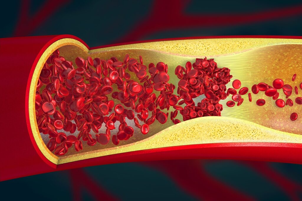 cardiologista-cita-sinais-do-corpo-que-podem-indicar-arteria-entupida