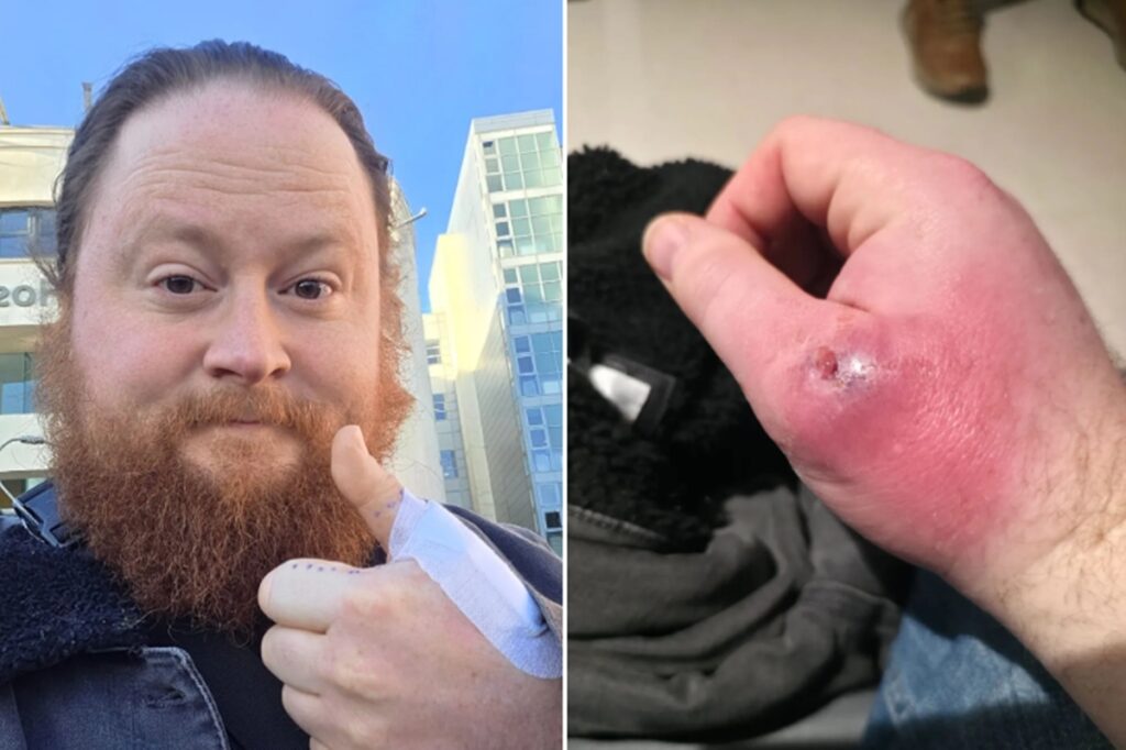 falsa-viuva-negra:-homem-e-picado-na-mao-e-precisa-passar-por-cirurgia