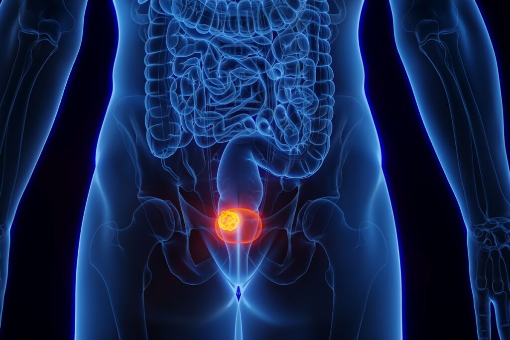 estudo-aponta-qual-e-a-relacao-entre-daltonismo-e-cancer-de-bexiga