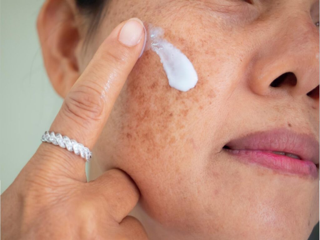 melasma-tem-cura?-veja-o-que-realmente-funciona-no-tratamento