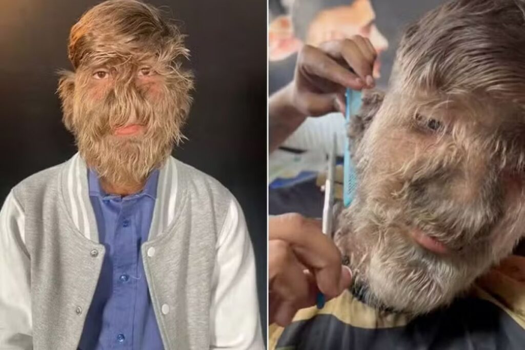 “sindrome-de-lobisomem”:-jovem-com-condicao-rara-vira-influencer