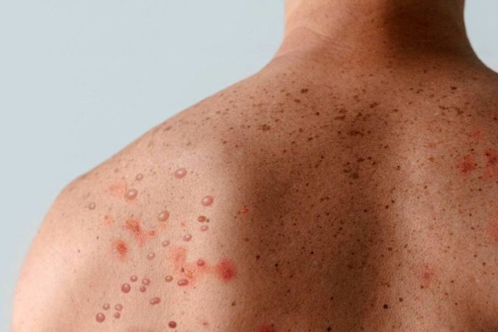 minas-ja-tem-13-casos-de-mpox-confirmados-e-monitora-doenca