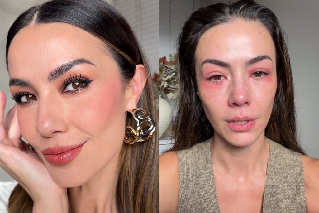 influencer-revela-forte-crise-alergica-e-expoe-como-esta-o-rosto.-veja