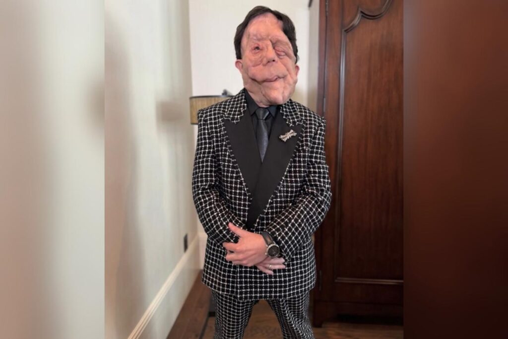 neurofibromatose:-entenda-doenca-rara-do-ator-adam-pearson