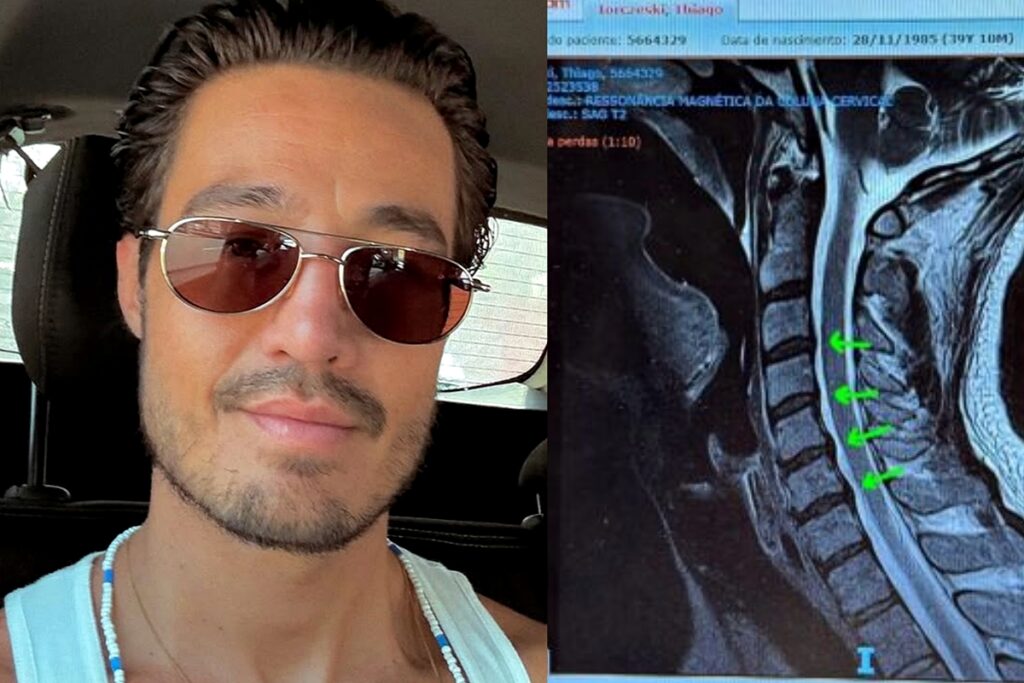 hernia:-ortopedista-revela-riscos-e-como-prevenir-quadro-de-tiago-iorc