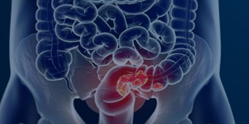 rastreamento-para-cancer-colorretal-pode-ser-implementado-no-sus