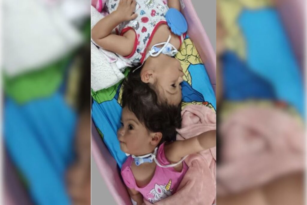 gemeas-siamesas-passam-por-4a-cirurgia-antes-de-separacao-definitiva