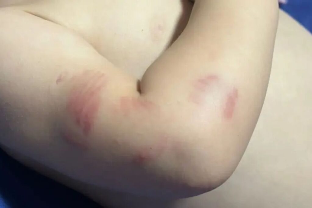 sc:-bebe-de-11-meses-volta-da-creche-com-mordidas-e-policia-investiga