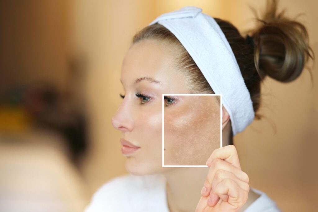 secador-de-cabelo-pode-piorar-o-melasma?-entenda-os-riscos-a-pele