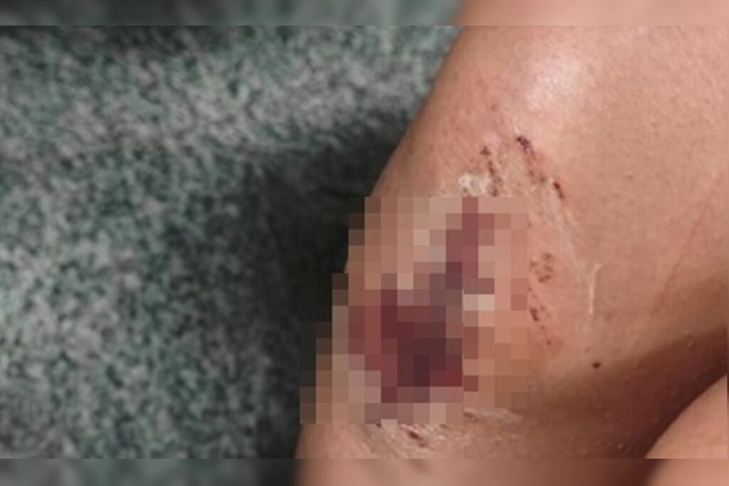 jovem-fica-com-feridas-em-carne-viva-apos-ser-espancada-por-irmao-e-ex-no-df