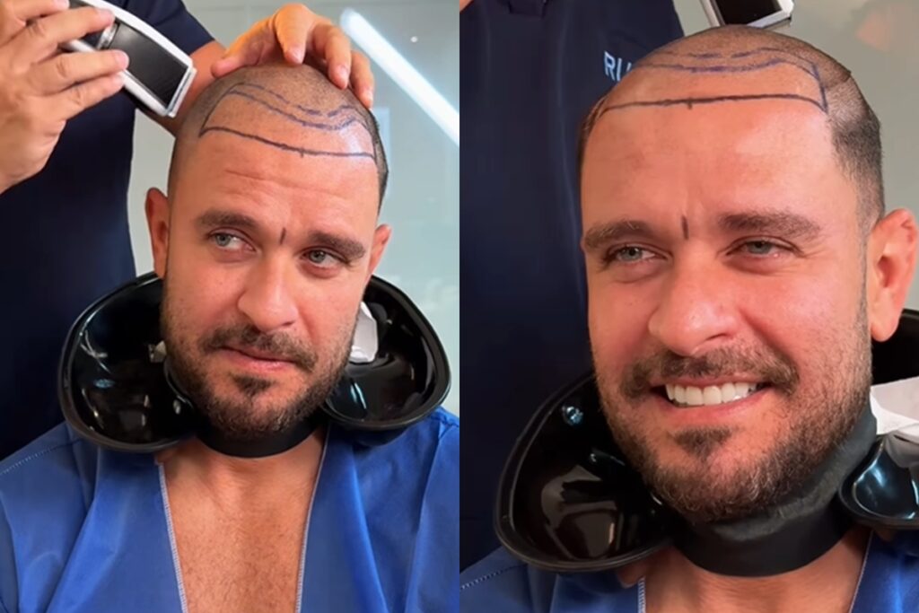 caso-diogo-nogueira:-quando-e-preciso-refazer-o-transplante-capilar?