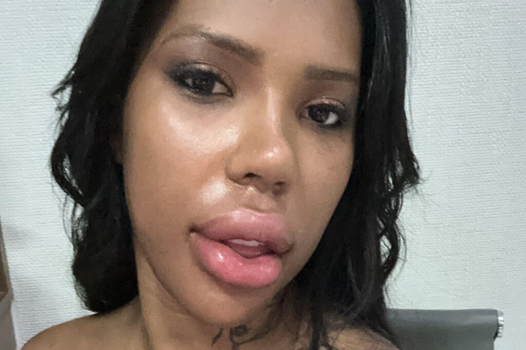 entenda-o-que-aconteceu-com-labios-de-carol-lekker-apos-procedimento.-veja-video