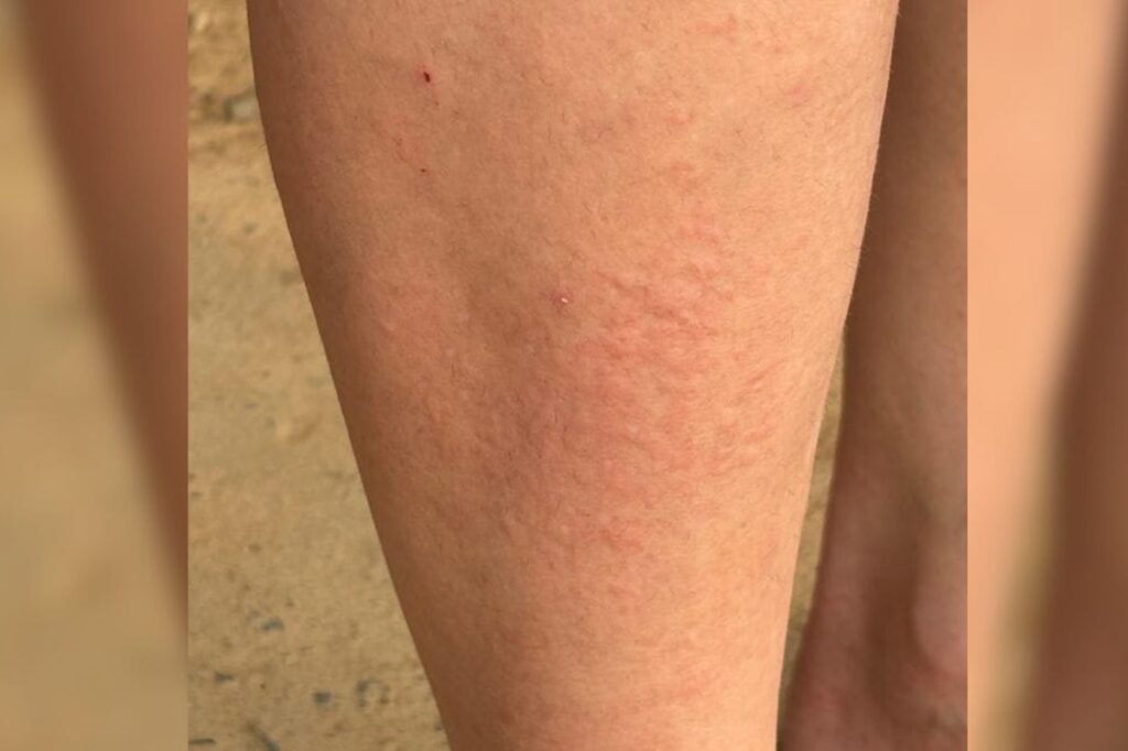 moradores-de-sc-usam-luvas-no-calor-contra-infestacao-de-mosquitos