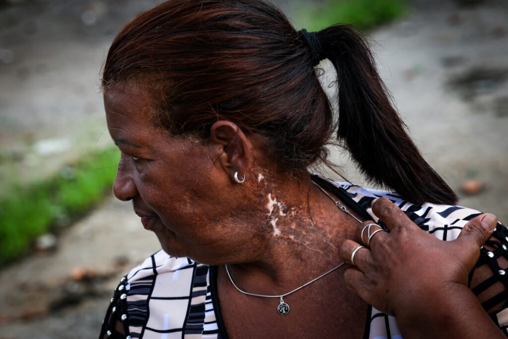 fotos:-veja-como-estao-sobreviventes-do-cesio-137-em-goiania-hoje