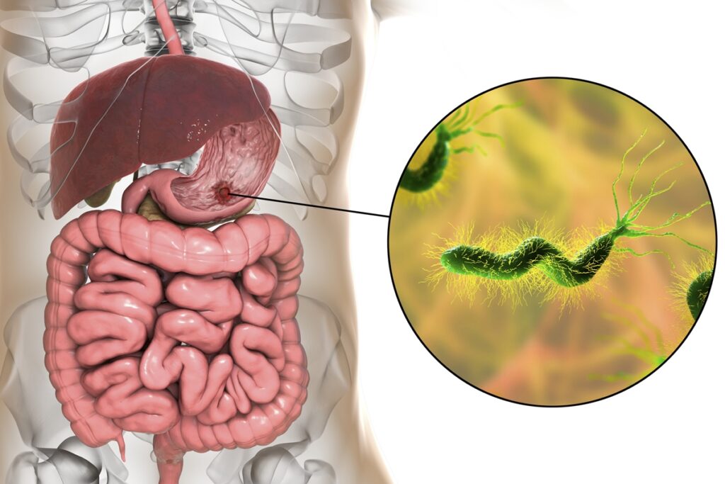 gastroenterologista-explica-o-contagio-da-bacteria-h.-pylori