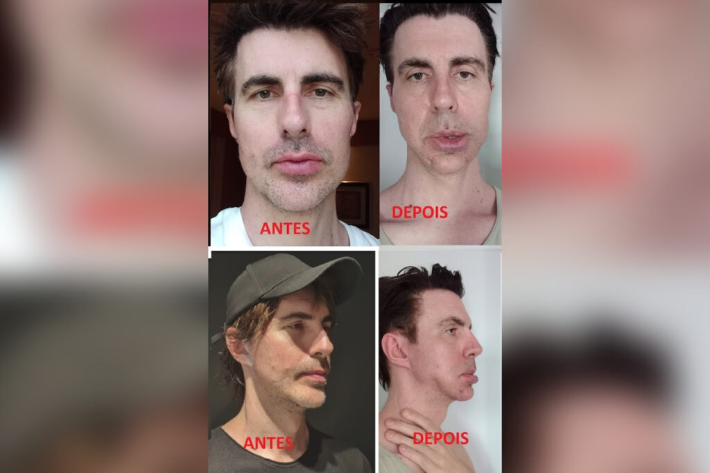 pacientes-acusam-dentista-de-deformacoes-apos-procedimentos-faciais.-veja-video