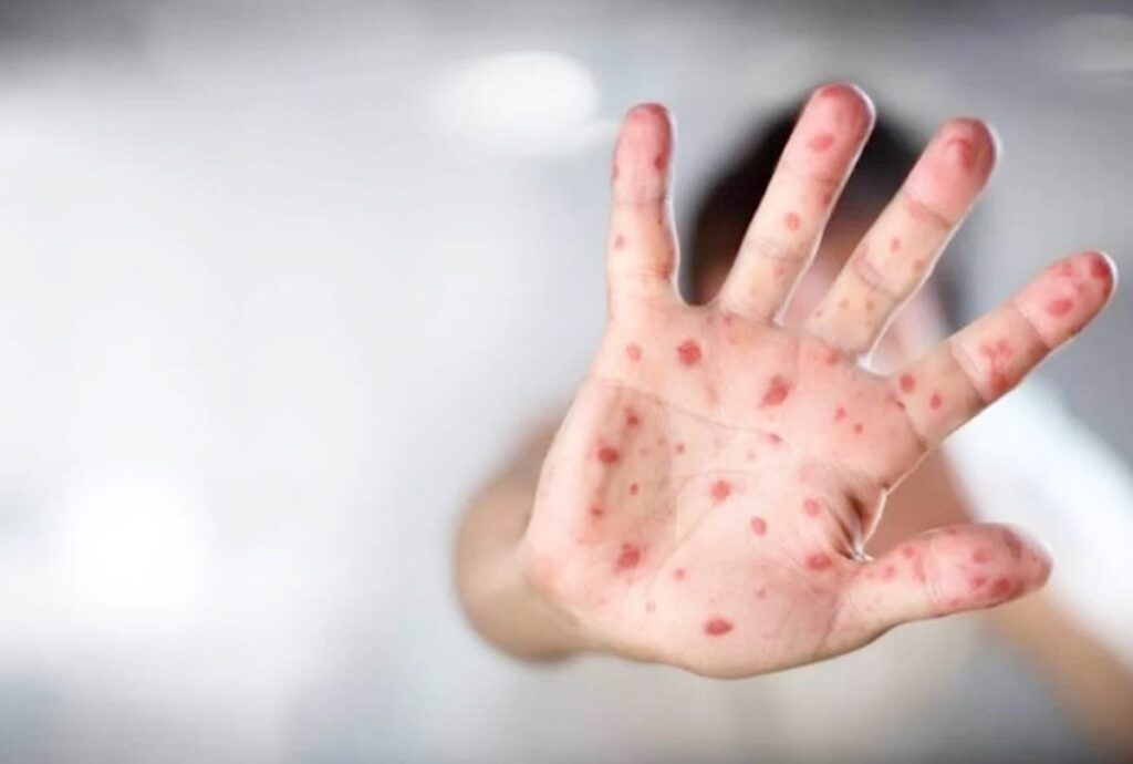 alta-de-sarampo-nas-americas-leva-df-a-reforcar-imunizacao