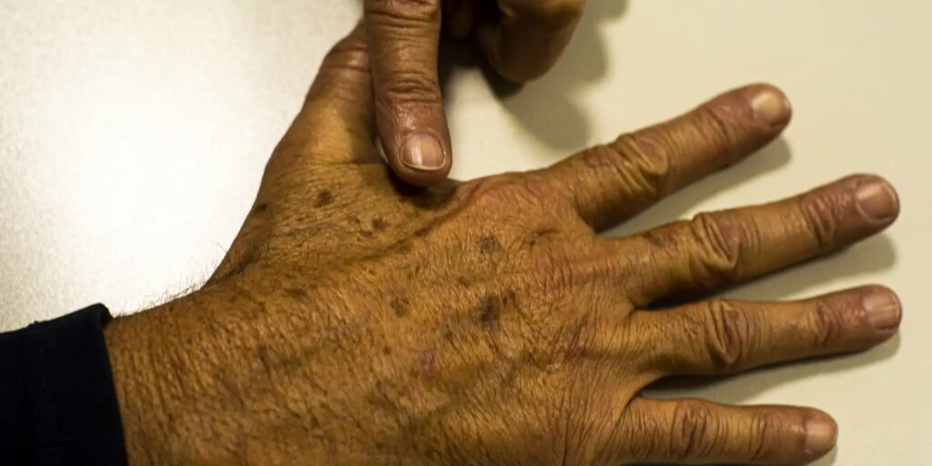 Desinformação sobre câncer de pele afeta diagnóstico, diz instituição desinformacao-sobre-cancer-de-pele-afeta-diagnostico,-diz-instituicao