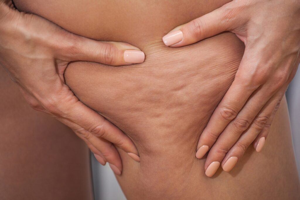 celulite-e-hormonios:-como-as-fases-da-vida-moldam-o-corpo-feminino