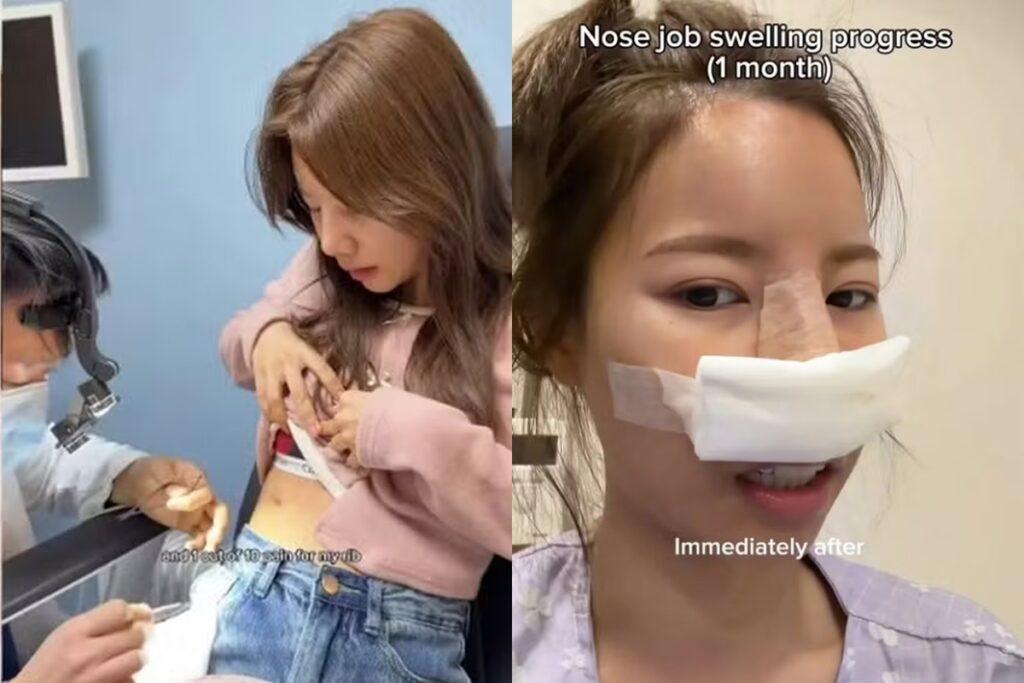 influencer-tira-cartilagem-da-costela-para-“arrumar”-plastica-no-nariz