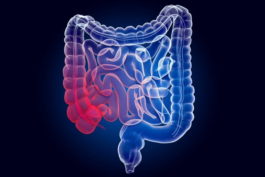coloproctologista-aponta-como-desinflamar-o-intestino-de-forma-natural