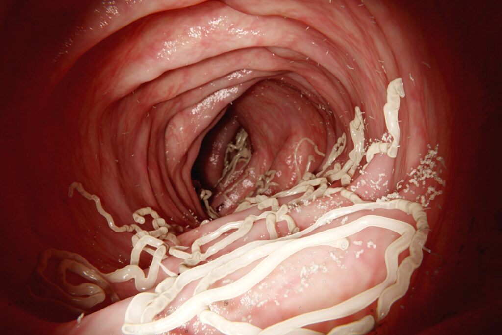 infectologista-cita-sinais-silenciosos-da-contaminacao-por-vermes