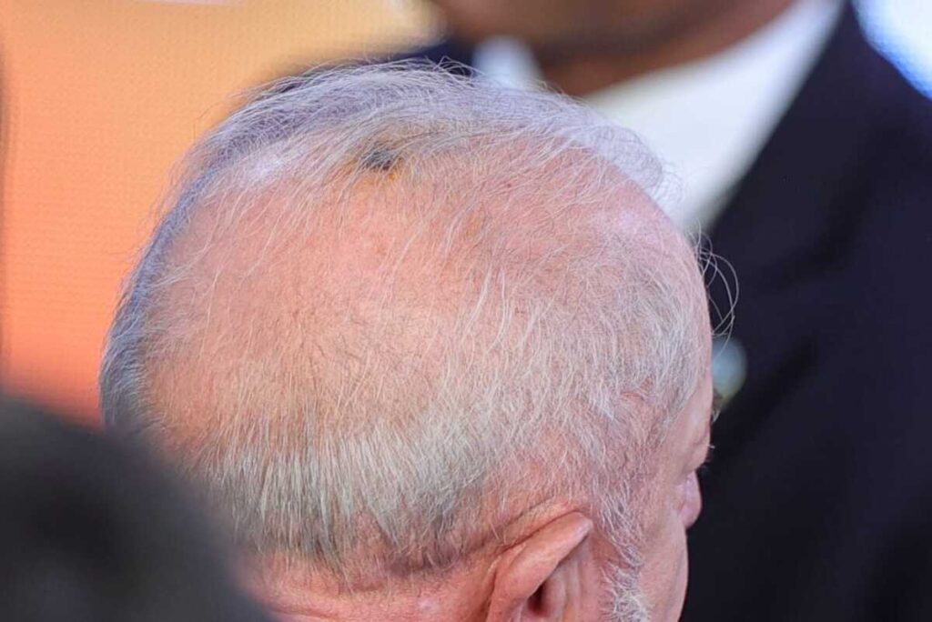 lula-vai-retirar-queratose-na-cabeca;-entenda-o-que-e-o-procedimento