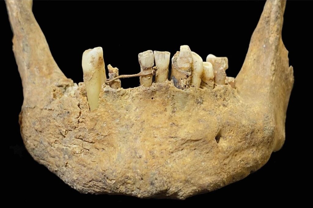 ponte-dentaria-de-ouro-com-500-anos-e-encontrada-na-escocia