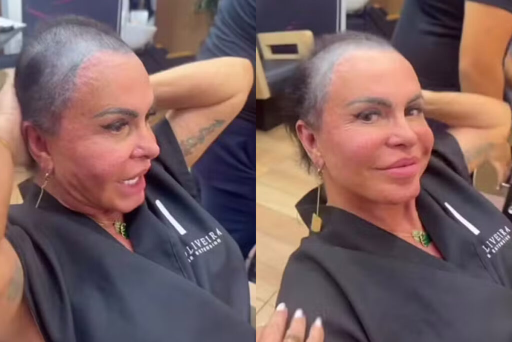 gretchen-diz-que-procedimento-prejudicou-cabelo-e-aumentou-alopecia
