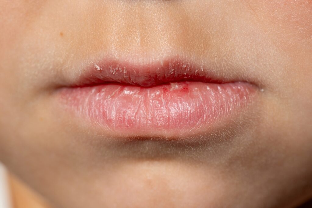 labios-rachados-no-frio?-veja-o-truque-para-recuperar-a-hidratacao
