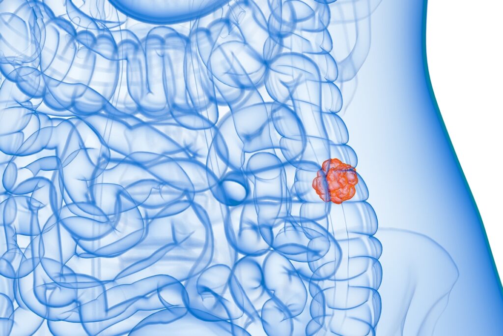 sus-adotara-exame-nao-invasivo-para-identificar-cancer-de-intestino