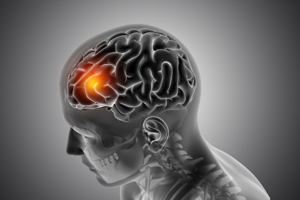 neurologista-revela-sinais-“silenciosos”-do-avc-que-muita-gente-ignora