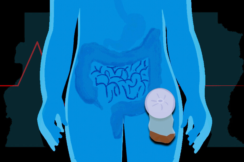por-que-pacientes-que-usam-bolsas-de-colostomia-temem-infeccao-no-df