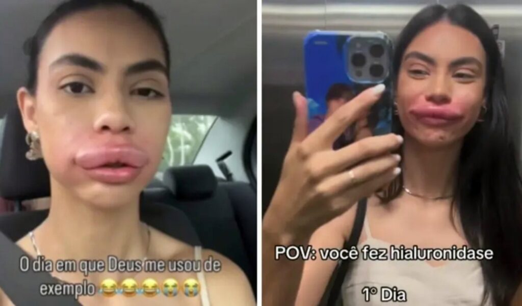 modelo-de-sc-fica-irreconhecivel-ao-remover-preenchimento-labial