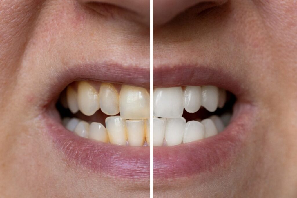 alerta:-receitas-caseiras-para-tirar-tartaro-trazem-riscos-aos-dentes