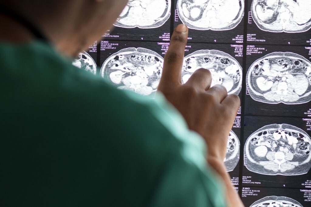 medicamento-contra-vermes-pode-ajudar-a-tratar-cancer-cerebral