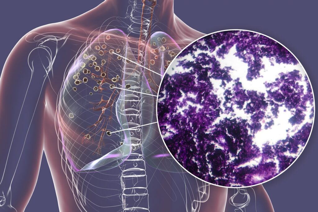 pesquisa-descobre-mutacao-genetica-relacionada-ao-cancer-de-pulmao