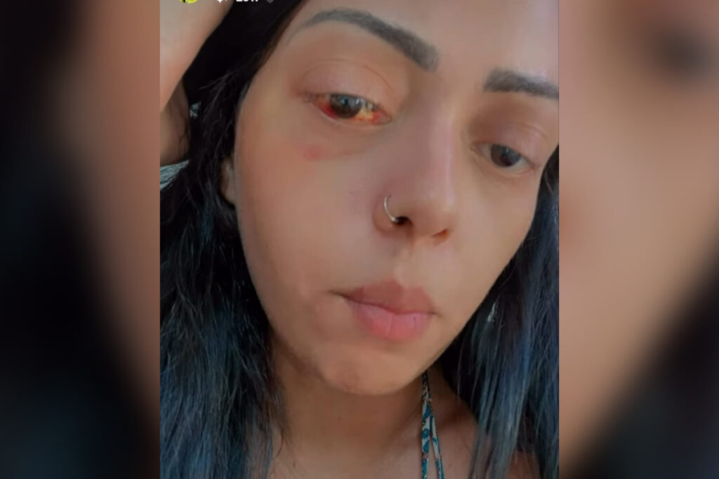 “queria-me-cegar”:-mulher-relata-emboscada-cruel-do-ex-namorado-em-mg